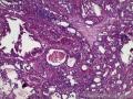 右侧乳腺肿物：小叶癌？腺病？图9