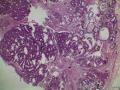 右侧乳腺肿物：小叶癌？腺病？图2