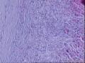 56岁，甲状腺肿物。图1