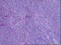 56岁，甲状腺肿物。图21