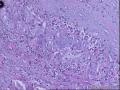56岁，甲状腺肿物。图5