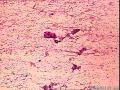 乳腺穿刺细胞，求教图11