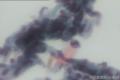 宫颈癌术后怎么报。是颈管细胞吧？？怎么会出现这样的细胞呢？图17