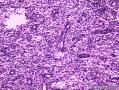 子宫及卵巢肿物请大家帮我看看。图12