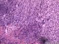 子宫及卵巢肿物请大家帮我看看。图14