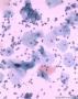40，体检。半年前呈患甲状腺癌图7