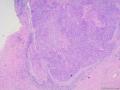 宫颈CIN III  or  Ca?图3