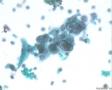 宫颈液基细胞图5
