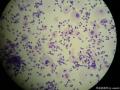 43岁TCT，有组织学结果图19