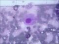 腋窝淋巴结穿刺图18