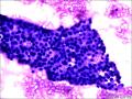 甲状腺FNA图8