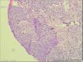 乳腺细针穿刺组织快速石蜡切片可以报恶性么？图2