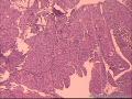 癌应该确定的哈，不知道有没有浸润图10