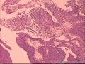 癌应该确定的哈，不知道有没有浸润图9