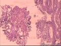 癌应该确定的哈，不知道有没有浸润图21