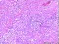 求助，子宫内容物，是个什么肿瘤？谢谢图5