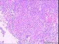 求助，子宫内容物，是个什么肿瘤？谢谢图2