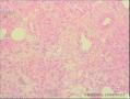 右大腿结节性筋膜炎？图3