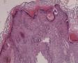 右大腿皮肤肿物图6