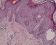 右大腿皮肤肿物图9