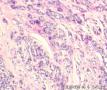 女 55岁 头皮包块   有乳腺癌病史  求助图5