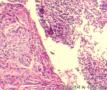 淋巴结转移性高中分化鳞癌  伴周围组织浸润图3