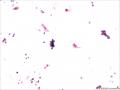 膀胱占位，尿液细胞学图13