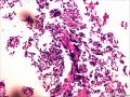 是什么？腺泡状软组织肉瘤？Ｐｃｏｍａ?副神经节瘤？图11