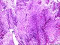 是什么？腺泡状软组织肉瘤？Ｐｃｏｍａ?副神经节瘤？图6
