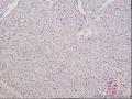 胸壁肿物，帮忙看看图5