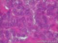 甲状腺左侧胚胎型腺瘤？右侧滤泡性腺瘤？1-18左侧 19-24右侧图13
