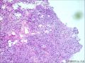 子宫内膜间质肉瘤（高级别）图2