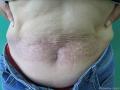 小草典型病例之六------面颈部、腹部色素斑、痒图2