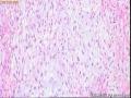 前列腺罕见肿瘤您怎么看？？重新上传了图片图17