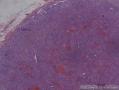 左侧腋窝淋巴结肿大图2