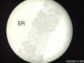 孔祥田老师病例讨论32 yo F metastatic breast ca 已点评图5