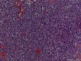 左侧腋窝淋巴结肿大图19