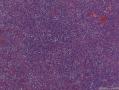 左侧腋窝淋巴结肿大图10