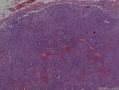 左侧腋窝淋巴结肿大图5