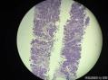 孔祥田老师病例讨论32 yo F metastatic breast ca 已点评图1
