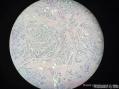 孔祥田老师病例讨论32 yo F metastatic breast ca 已点评图8