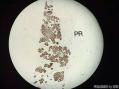 孔祥田老师病例讨论32 yo F metastatic breast ca 已点评图4