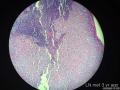 孔祥田老师病例讨论32 yo F metastatic breast ca 已点评图9