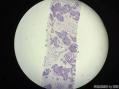 孔祥田老师病例讨论32 yo F metastatic breast ca 已点评图2