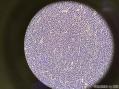 孔祥田老师病例讨论 59 yo F tonsils,tonsillectomy.已点评图4