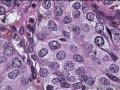 左乳肿物及左腋下肿物图12