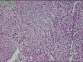 宫颈活检，高级别？图14