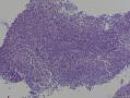 淋巴结肿大图8