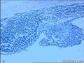左侧腹股沟区肿物图21