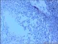 左侧腹股沟区肿物图12